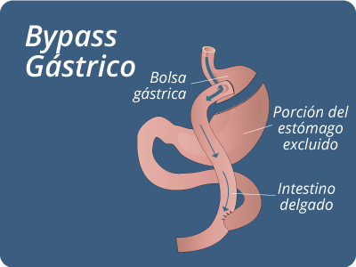 Bypass Gastrico barranquilla colombia